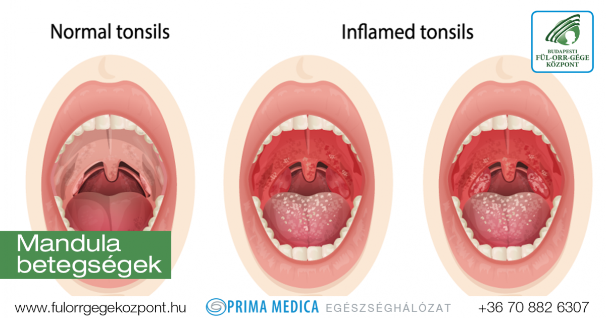 A tüszős mandulagyulladás (tonsillitis follicularis) tünetei és kezelése