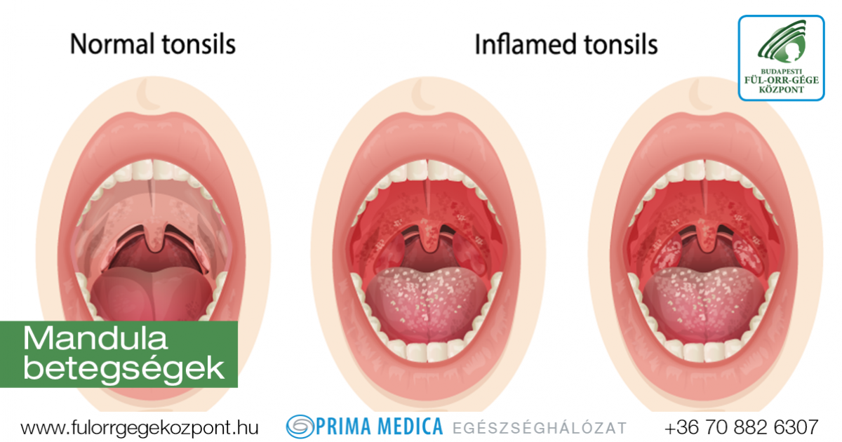 meddig kell pikkelysömör kezelésére hamis psoriasis kezelse