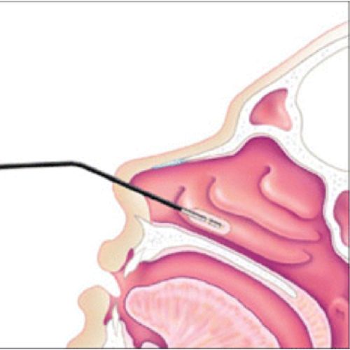 Horkolás - Fül-orr-gége Központ
