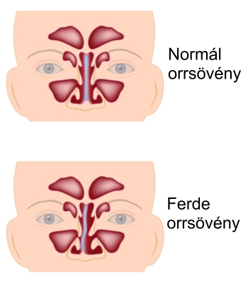 orsoveny